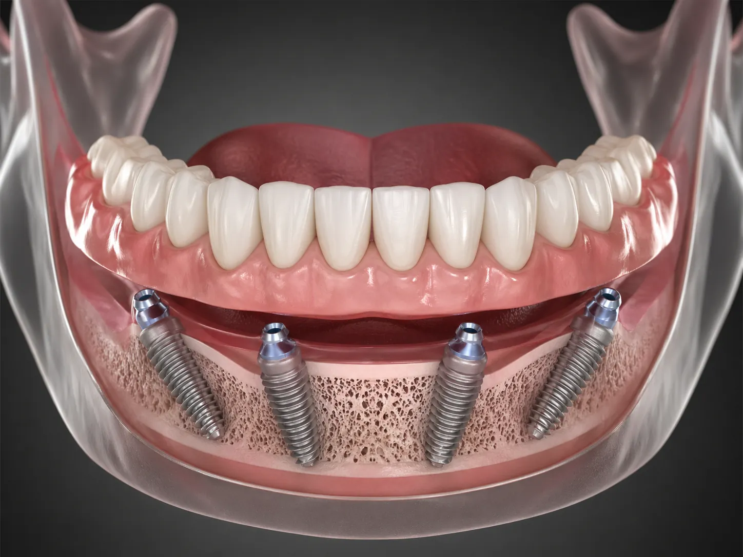 All-on-Four ve All-on-Six implant planlaması görseli